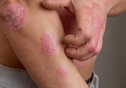 Psoriasis natuurlijk behandelen OERsterk.nu