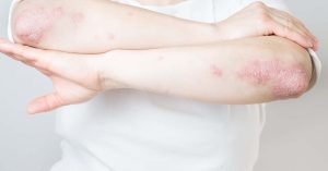 Psoriasis